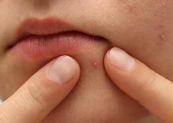 Pimples