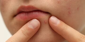 Pimples