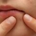 Pimples
