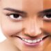 Skin Tanning