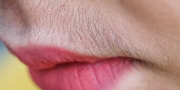 Unwanted Hair