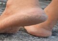 cracked heels