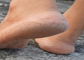 cracked heels