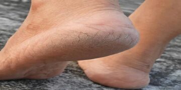 cracked heels