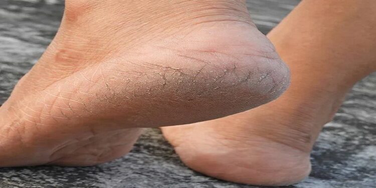 cracked heels