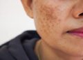 Pigmentation