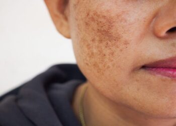 Pigmentation