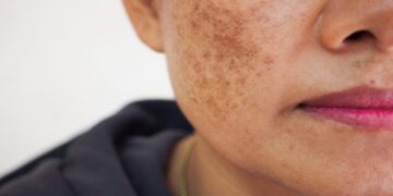 Pigmentation