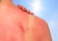 Sunburn