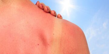 Sunburn