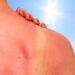Sunburn